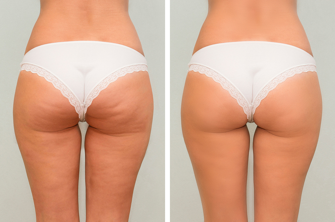 efectos-presoterapia-antes-despues